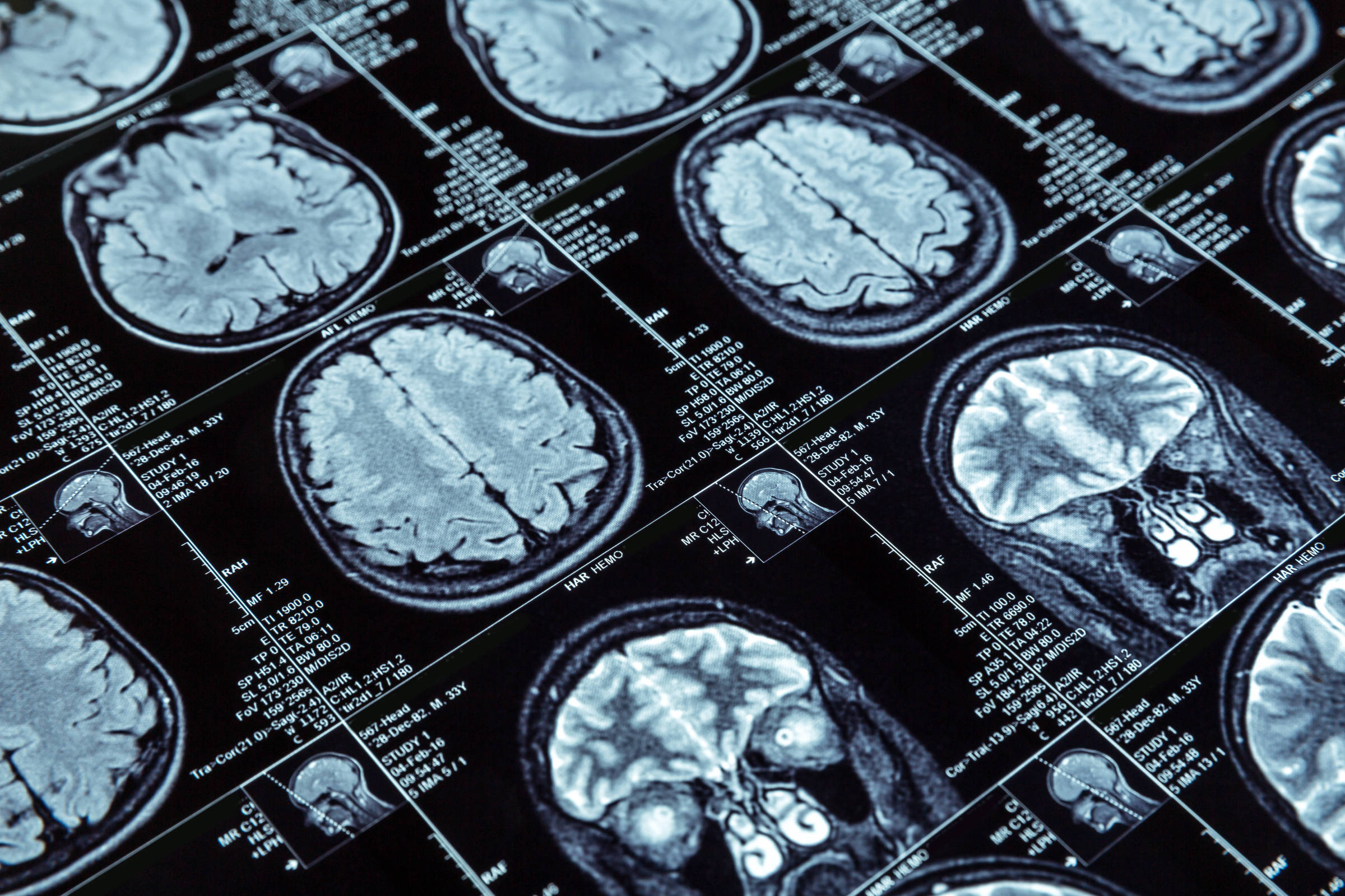 Estudo brasileiro revela relação entre inflamação cerebral e Alzheimer