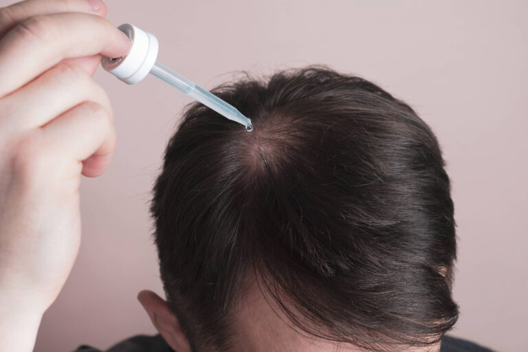 Entenda os principais tipos de queda de cabelo e seus tratamentos eficazes