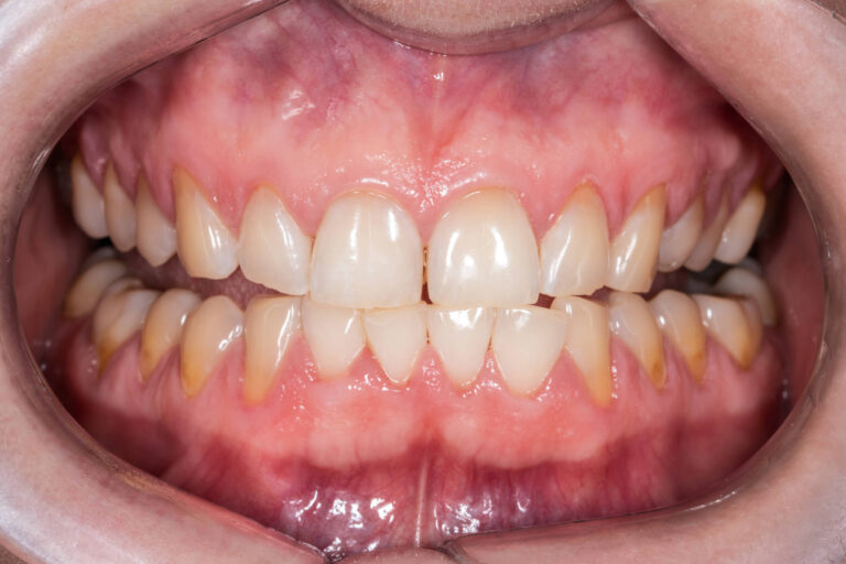 Entenda os fatores que contribuem para a erosão dentária