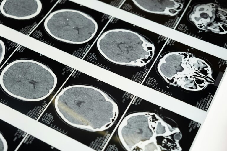 Doenças priônicas: os enigmas das proteínas que destroem o cérebro