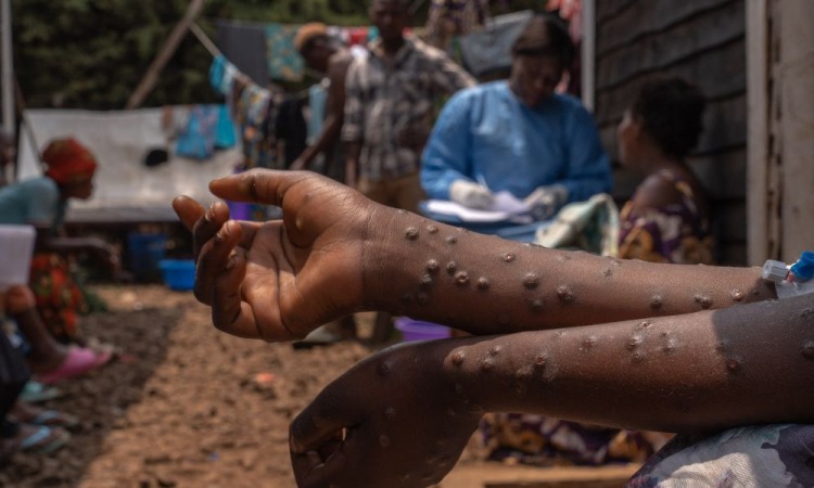 Brasil registra primeiro caso da nova cepa 1b de mpox