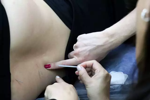 Acupuntura Gratuita Chega ao SUS de MS: Médicos se Capacitam para Ampliar Acesso
