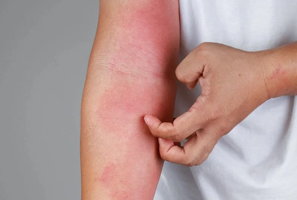 Dermatite Atópica: Por que a Doença de Pele Aumenta em Jovens e Adultos?